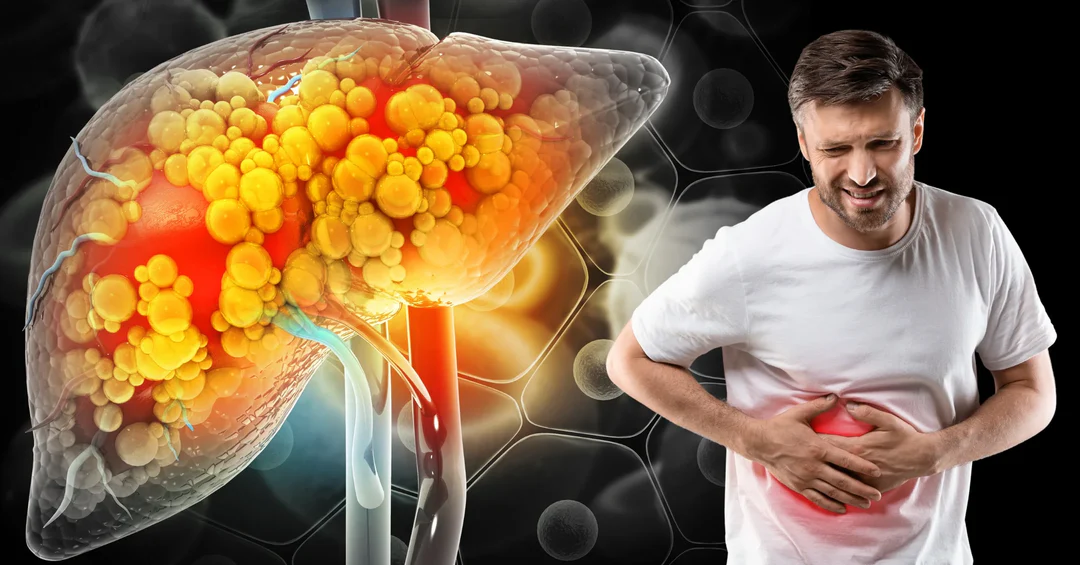 Early Signs of Fatty Liver: Symptoms You Should Never Ignore