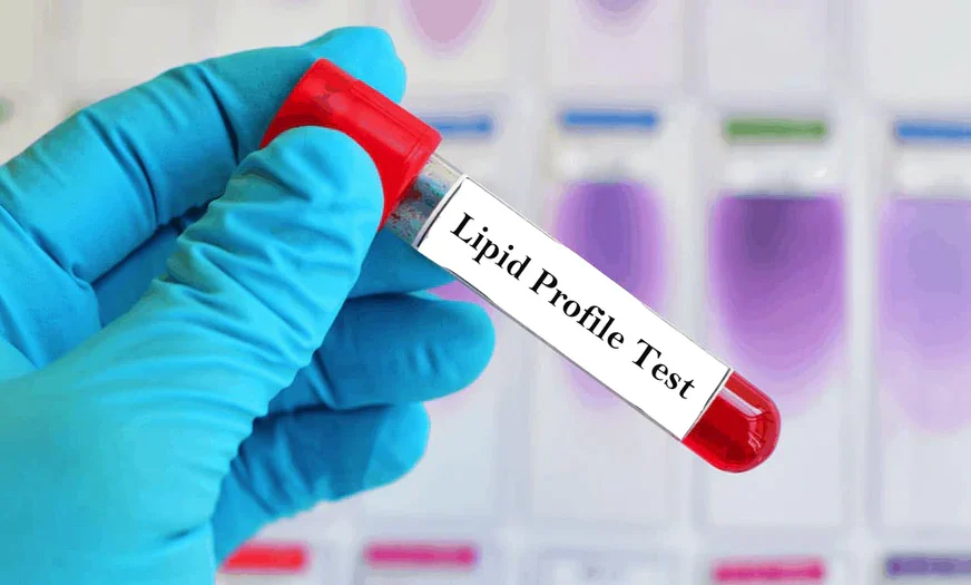Understanding Your Lipid Profile: What Do Your Cholesterol Numbers Actually Mean?