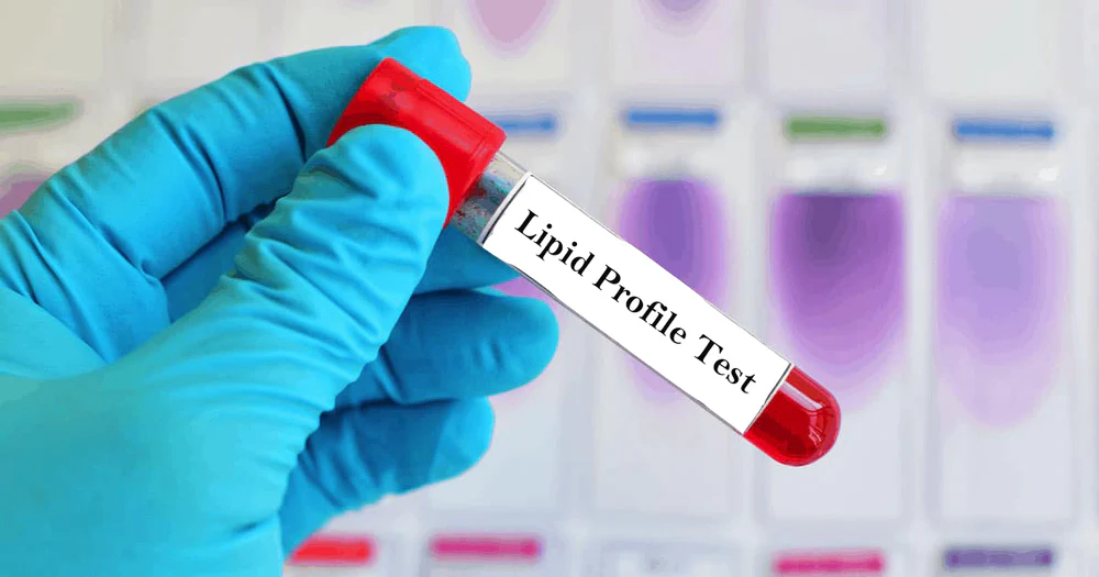 Understanding Your Lipid Profile: What Do Your Cholesterol Numbers Actually Mean?