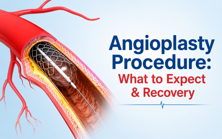 Angioplasty Procedure: What to Expect & Recovery