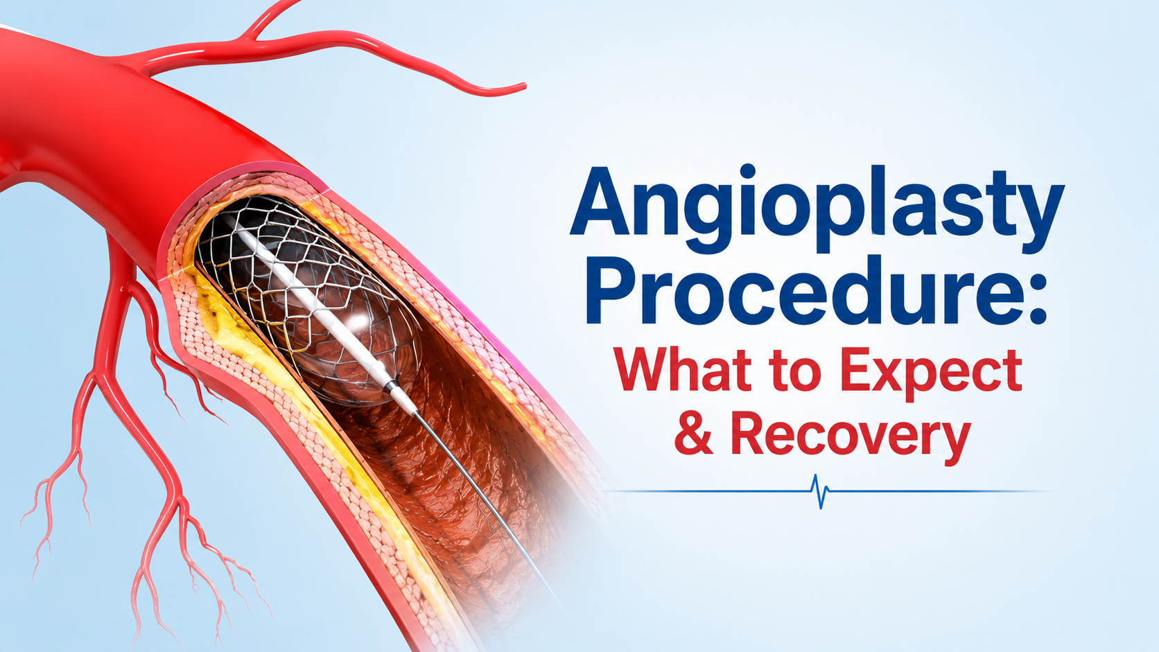 Angioplasty Procedure: What to Expect & Recovery