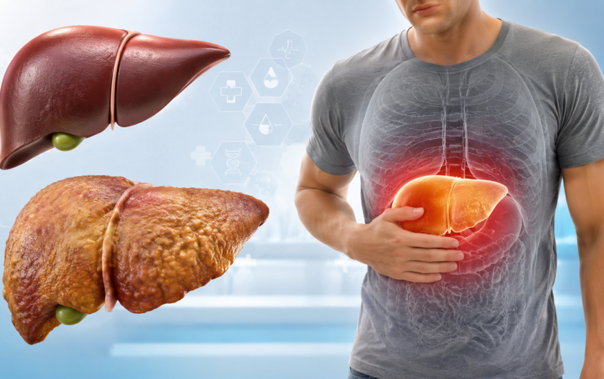 Early Signs of Fatty Liver: Symptoms You Should Never Ignore