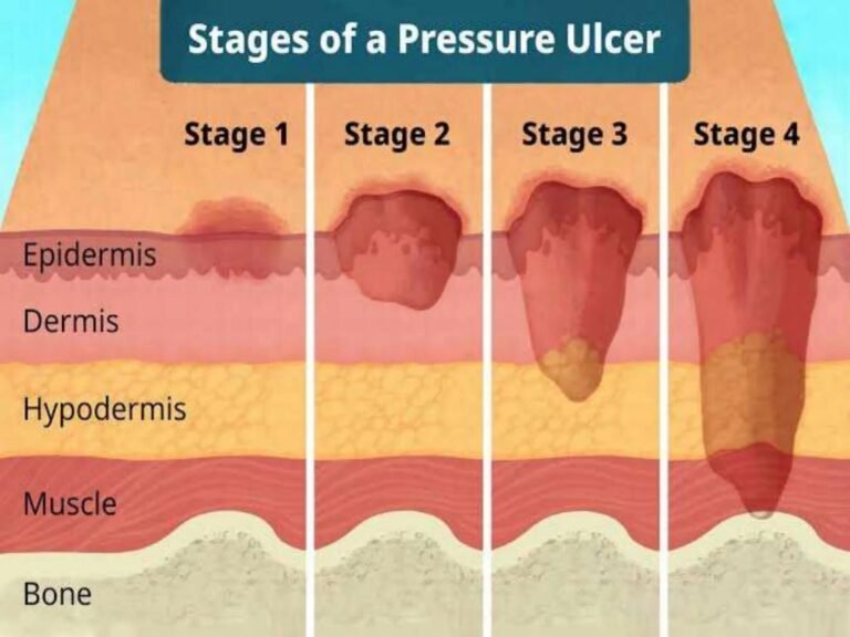 Bed sores treatment and the four stages of pressure sore damage