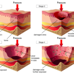Bed sores treatment for pressure ulcers and skin damage