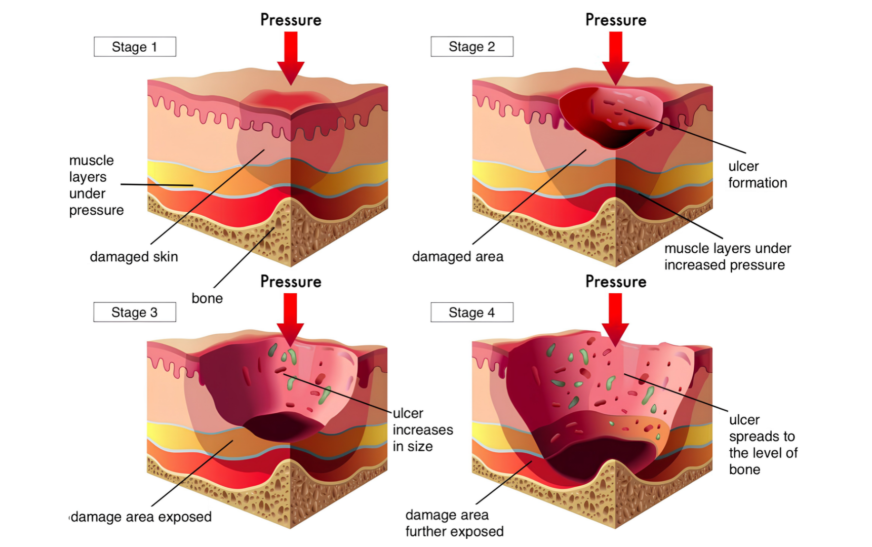 Bed Sores Treatment: 7 Effective Ways to Heal Pressure Sores