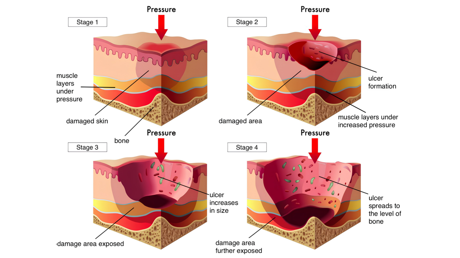 Bed Sores Treatment: 7 Effective Ways to Heal Pressure Sores